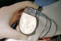 В Зеленограде пациенту впервые вживили «умный» дефибриллятор